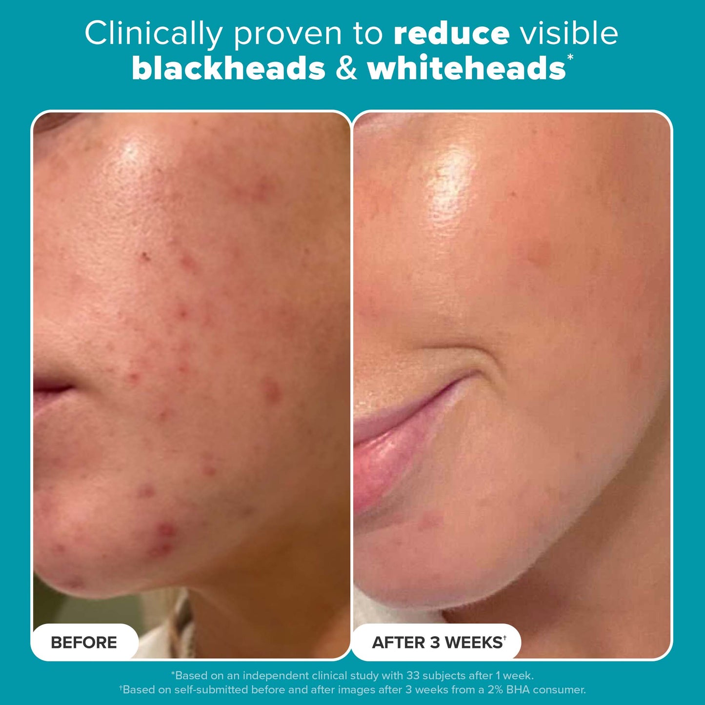 Cerave Blemish Control Cleanser (236ml) (Original)