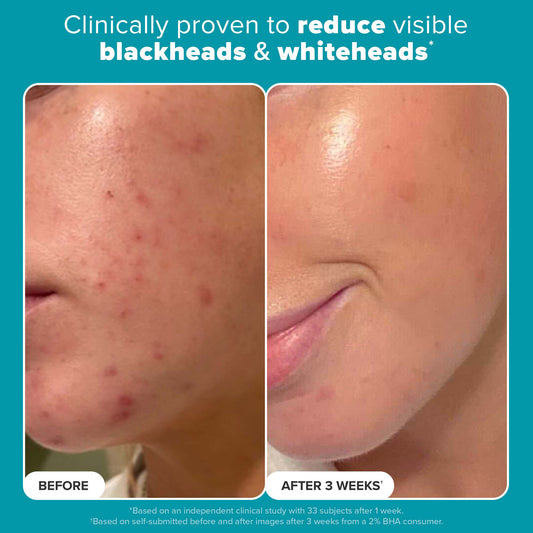 Cerave Blemish Control Cleanser (236ml) (Original)