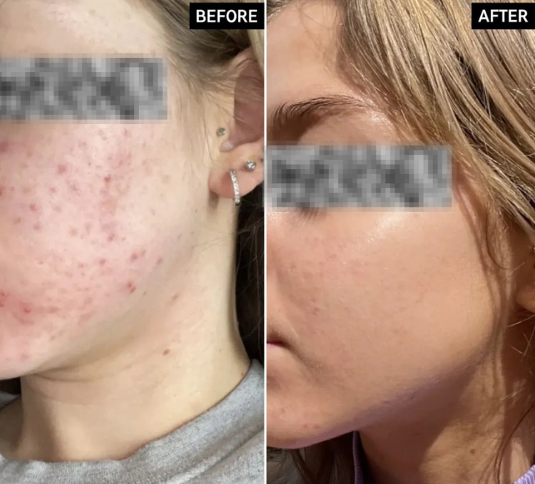 Ordinary Niacinamide 10% + Zinc 1% Serum (Original)