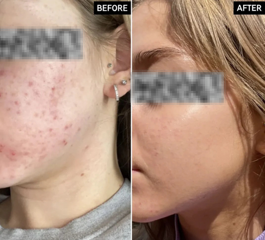 Ordinary Niacinamide 10% + Zinc 1% Serum (Original)