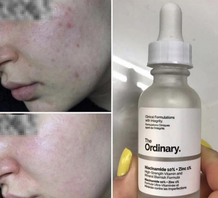 Ordinary Niacinamide 10% + Zinc 1% Serum (Original)